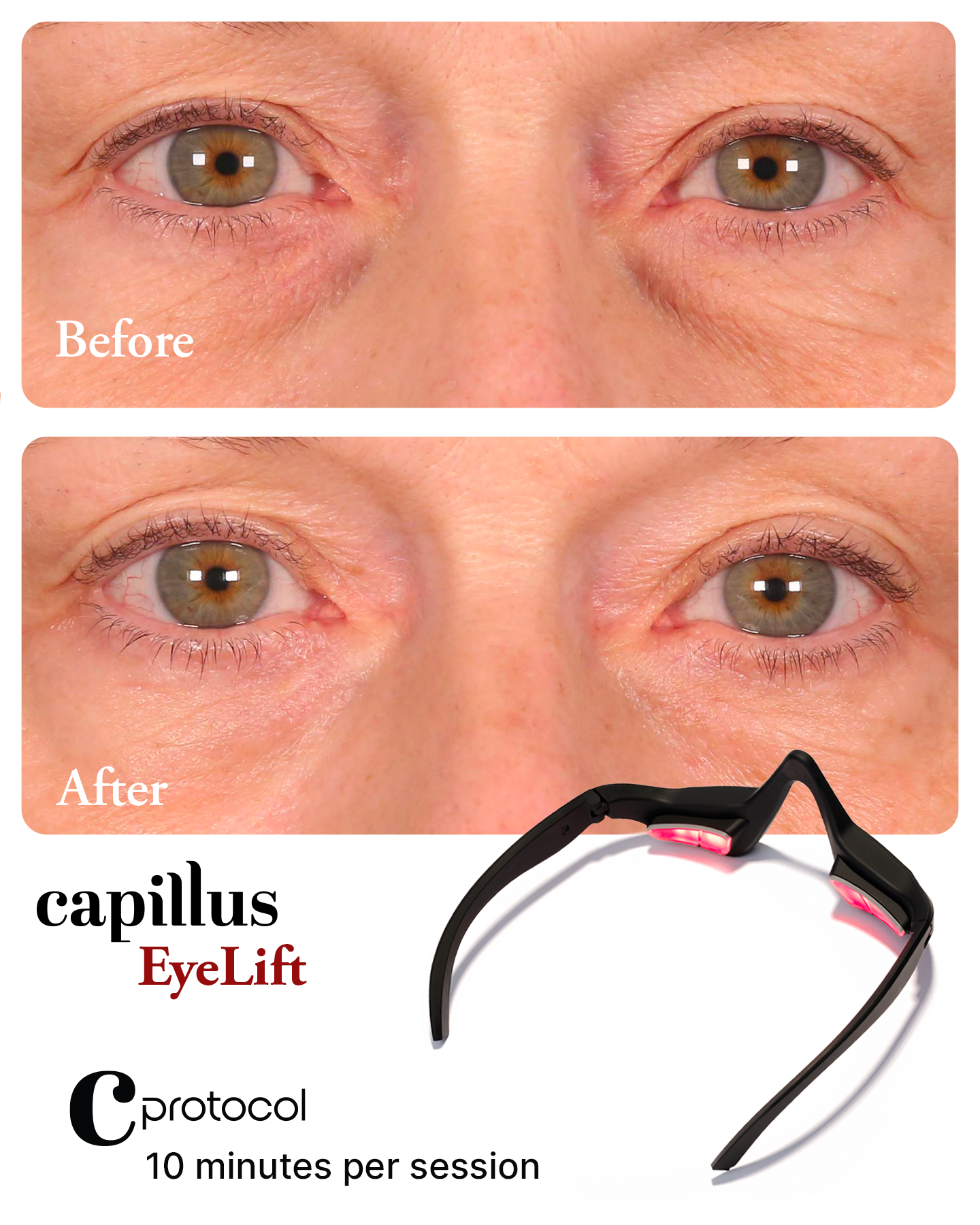 Capillus EyeLift before and after ad